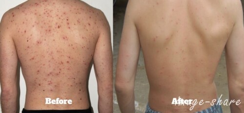 Male Acne Treatment